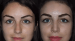 Best Rhinoplasty Surgeons in Dubai: Top Choices for Nose Surgery